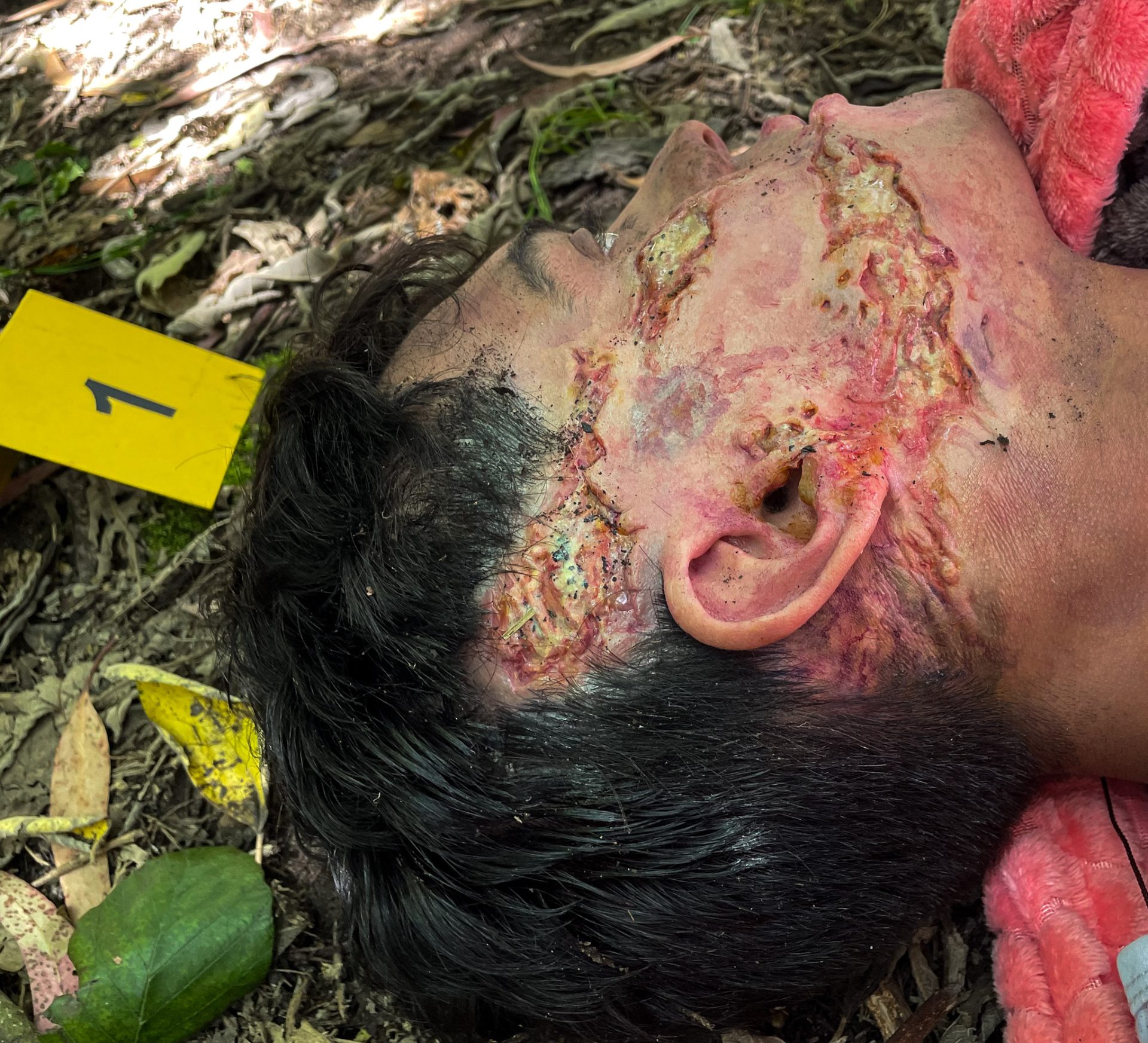 El Joven de la Foto Proceso de Quemadura